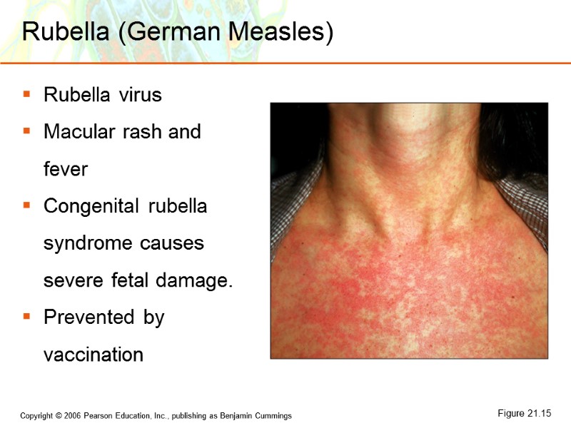 Rubella (German Measles) Rubella virus Macular rash and fever Congenital rubella syndrome causes severe